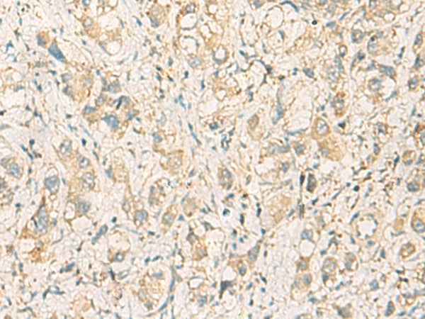 Immunohistochemistry of paraffin-embedded Human liver cancer tissue using F11R Polyclonal Antibody at dilution of 1:40(×200)