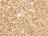 Immunohistochemistry of paraffin-embedded Human liver cancer tissue using JPT2 Polyclonal Antibody at dilution of 1:65(×200)