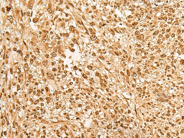 Immunohistochemistry of paraffin-embedded Human liver cancer tissue using JPT2 Polyclonal Antibody at dilution of 1:65(×200)