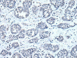 Immunohistochemistry of paraffin-embedded Human esophagus cancer tissue using RARG Polyclonal Antibody at dilution of 1:55(×200)