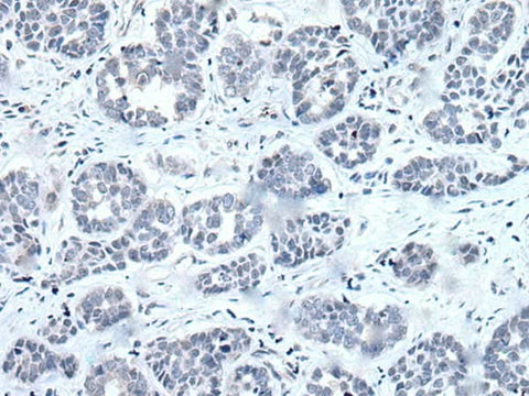 Immunohistochemistry of paraffin-embedded Human esophagus cancer tissue using RARG Polyclonal Antibody at dilution of 1:55(×200)