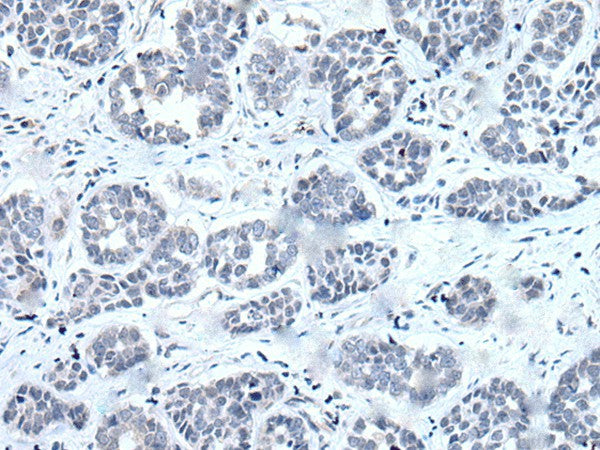 Immunohistochemistry of paraffin-embedded Human esophagus cancer tissue using RARG Polyclonal Antibody at dilution of 1:55(×200)