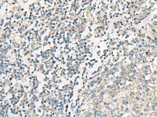 Immunohistochemistry of paraffin-embedded Human tonsil tissue using SERPINB4 Polyclonal Antibody at dilution of 1:40(×200)