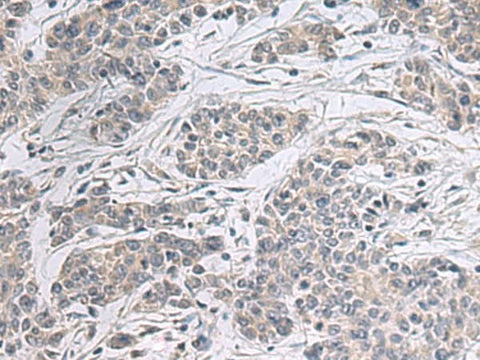 Immunohistochemistry of paraffin-embedded Human colorectal cancer tissue using PPM1K Polyclonal Antibody at dilution of 1:55(×200)