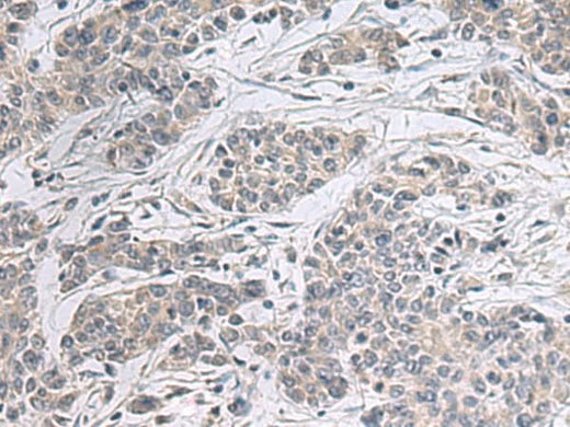 Immunohistochemistry of paraffin-embedded Human colorectal cancer tissue using PPM1K Polyclonal Antibody at dilution of 1:55(×200)