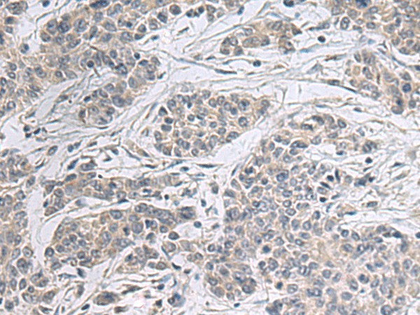 Immunohistochemistry of paraffin-embedded Human colorectal cancer tissue using PPM1K Polyclonal Antibody at dilution of 1:55(×200)