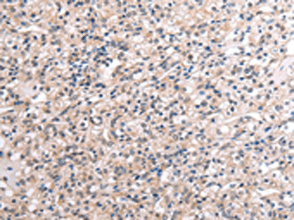 Immunohistochemistry of paraffin-embedded Human liver cancer tissue using RNF115 Polyclonal Antibody at dilution of 1:45(×200)