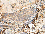 Immunohistochemistry of paraffin-embedded Human esophagus cancer tissue using HLA-DQB1 Polyclonal Antibody at dilution of 1:30(×200)
