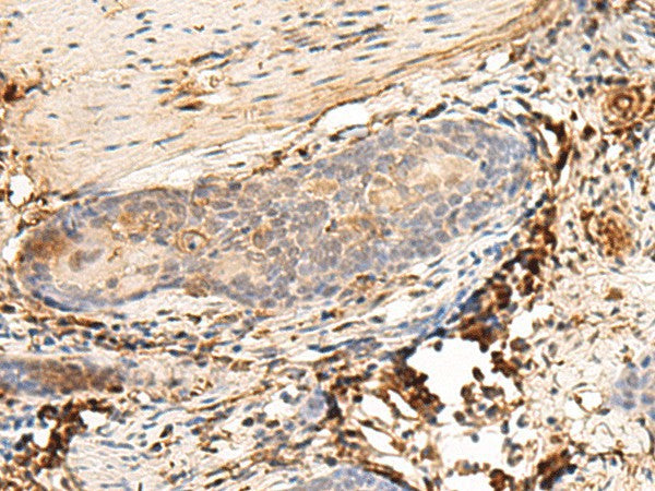 Immunohistochemistry of paraffin-embedded Human esophagus cancer tissue using HLA-DQB1 Polyclonal Antibody at dilution of 1:30(×200)