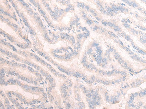 Immunohistochemistry of paraffin-embedded Human thyroid cancer tissue using TBC1D2 Polyclonal Antibody at dilution of 1:25(×200)