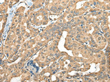Immunohistochemistry of paraffin-embedded Human thyroid cancer tissue using FAM110B Polyclonal Antibody at dilution of 1:40(×200)