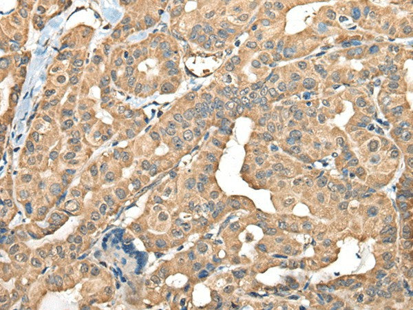 Immunohistochemistry of paraffin-embedded Human thyroid cancer tissue using FAM110B Polyclonal Antibody at dilution of 1:40(×200)