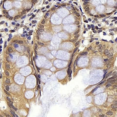 Immunohistochemistry analysis of paraffin-embedded human colon using BAD Polyclonal Antibody at dilution of 1:300.