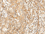 Immunohistochemistry of paraffin-embedded Human gastric cancer tissue using CD99 Polyclonal Antibody at dilution of 1:40(×200)