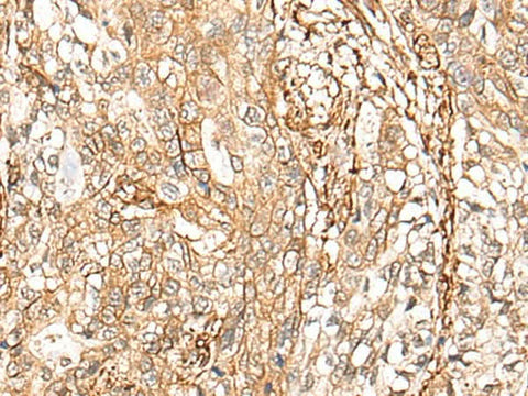 Immunohistochemistry of paraffin-embedded Human gastric cancer tissue using CD99 Polyclonal Antibody at dilution of 1:40(×200)