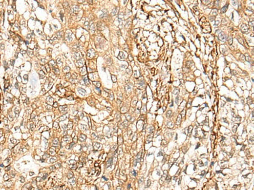 Immunohistochemistry of paraffin-embedded Human gastric cancer tissue using CD99 Polyclonal Antibody at dilution of 1:40(×200)