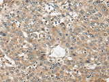 Immunohistochemistry of paraffin-embedded Human liver cancer tissue using FUT4 Polyclonal Antibody at dilution of 1:40(×200)