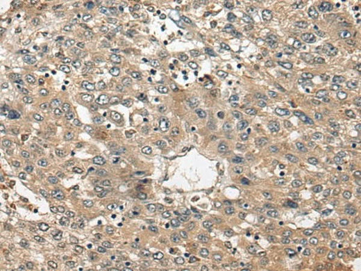 Immunohistochemistry of paraffin-embedded Human liver cancer tissue using FUT4 Polyclonal Antibody at dilution of 1:40(×200)