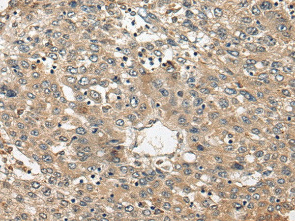 Immunohistochemistry of paraffin-embedded Human liver cancer tissue using FUT4 Polyclonal Antibody at dilution of 1:40(×200)