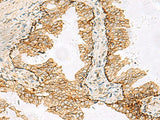 Immunohistochemistry of paraffin-embedded Human prost at e cancer tissue using SH3YL1 Polyclonal Antibody at dilution of 1:55(×200)