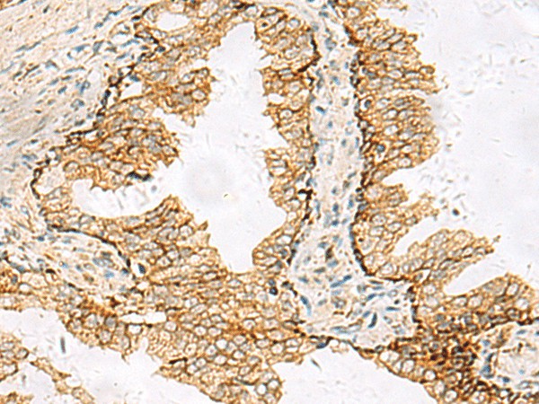 Immunohistochemistry of paraffin-embedded Human prost at e cancer tissue using SH3YL1 Polyclonal Antibody at dilution of 1:55(×200)