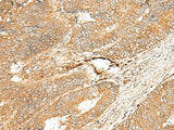 Immunohistochemistry of paraffin-embedded Human colorectal cancer tissue using ADGRF5 Polyclonal Antibody at dilution of 1:40(×200)