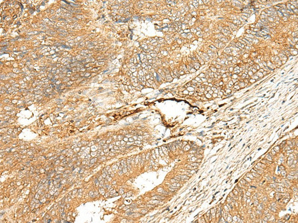 Immunohistochemistry of paraffin-embedded Human colorectal cancer tissue using ADGRF5 Polyclonal Antibody at dilution of 1:40(×200)