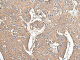 Immunohistochemistry of paraffin-embedded Human prost at e cancer tissue using KRT73 Polyclonal Antibody at dilution of 1:55(×200)