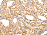 Immunohistochemistry of paraffin-embedded Human thyroid cancer tissue using DEF8 Polyclonal Antibody at dilution of 1:25(×200)
