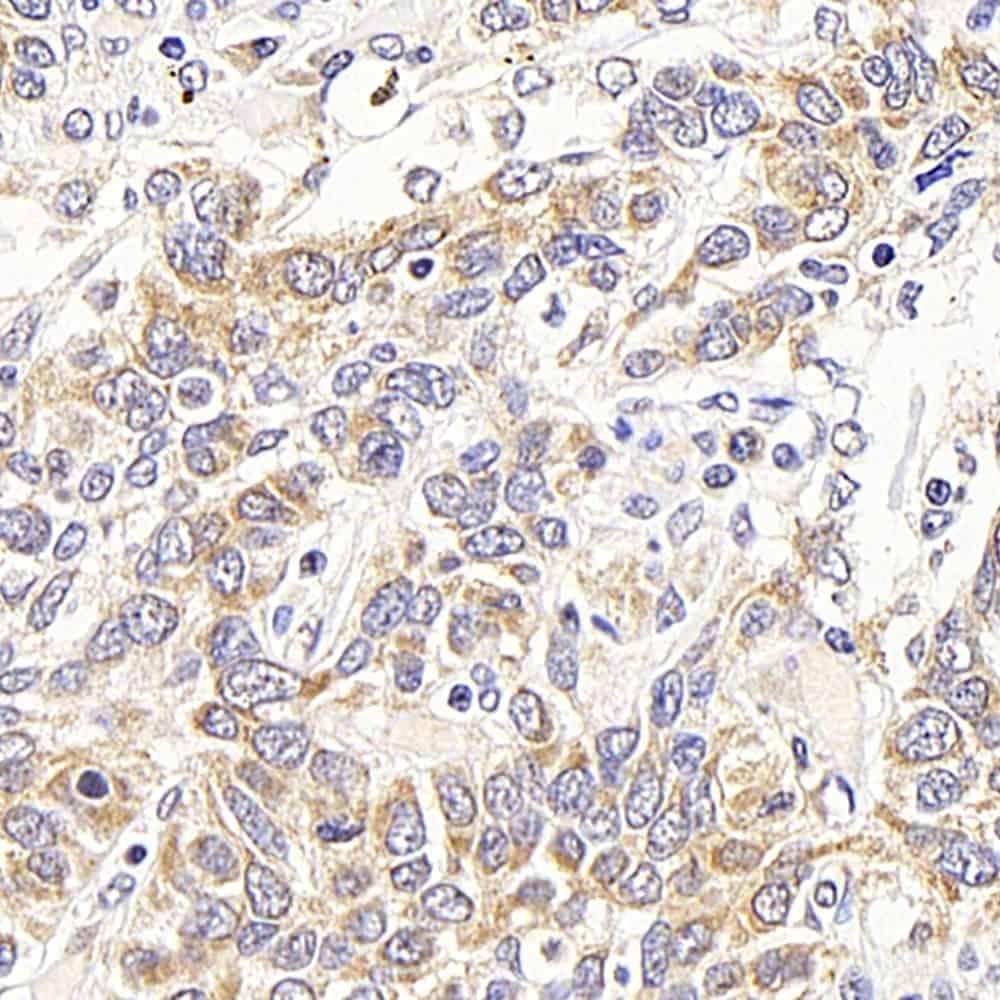 Immunohistochemistry analysis of paraffin-embedded human lung cancer using ATF2 Polyclonal Antibody at dilution of 1:400.