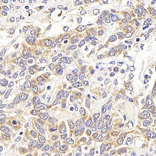Immunohistochemistry analysis of paraffin-embedded human lung cancer using ATF2 Polyclonal Antibody at dilution of 1:400.