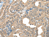 Immunohistochemistry of paraffin-embedded Human thyroid cancer tissue using CABP5 Polyclonal Antibody at dilution of 1:65(×200)
