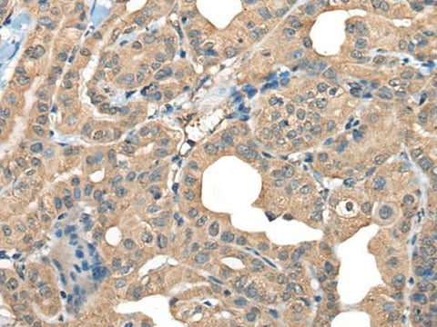 Immunohistochemistry of paraffin-embedded Human thyroid cancer tissue using CABP5 Polyclonal Antibody at dilution of 1:65(×200)