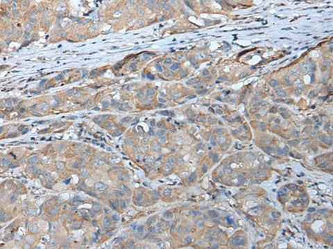 Immunohistochemistry of paraffin-embedded Human breast cancer tissue using GPC5 Polyclonal Antibody at dilution of 1:40(×200)