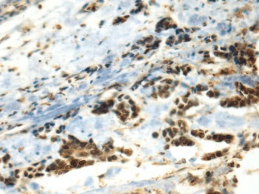 Immunohistochemistry of paraffin-embedded Human breast cancer tissue using DDX39A Polyclonal Antibody at dilution of 1:70(×200)