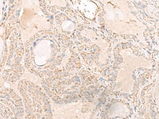 Immunohistochemistry of paraffin-embedded Human thyroid cancer tissue using IGHA1 Polyclonal Antibody at dilution of 1:65(×200)