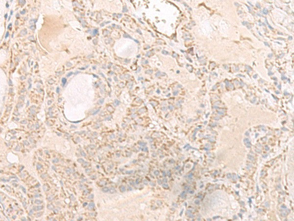 Immunohistochemistry of paraffin-embedded Human thyroid cancer tissue using IGHA1 Polyclonal Antibody at dilution of 1:65(×200)