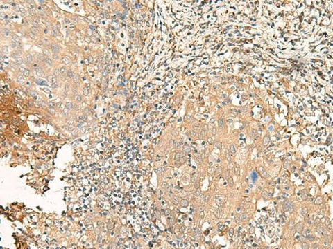 Immunohistochemistry of paraffin-embedded Human cervical cancer tissue using GALR2 Polyclonal Antibody at dilution of 1:25(×200)