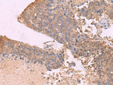 Immunohistochemistry of paraffin-embedded Human liver cancer tissue using KCNU1 Polyclonal Antibody at dilution of 1:45(×200)