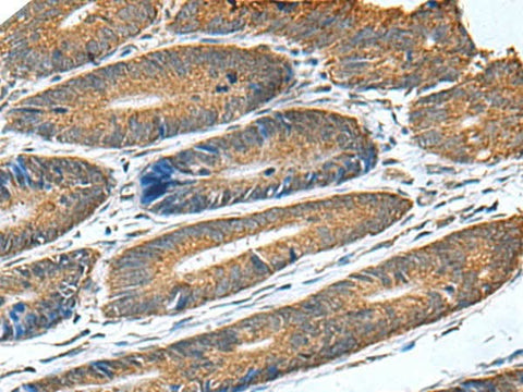 Immunohistochemistry of paraffin-embedded Human colorectal cancer tissue using HSD11B1 Polyclonal Antibody at dilution of 1:70(×200)