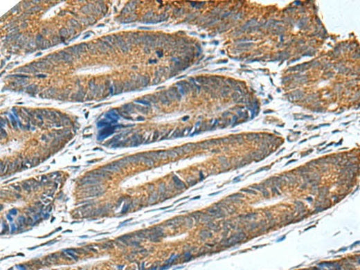 Immunohistochemistry of paraffin-embedded Human colorectal cancer tissue using HSD11B1 Polyclonal Antibody at dilution of 1:70(×200)