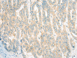 Immunohistochemistry of paraffin-embedded Human liver cancer tissue using CDKAL1 Polyclonal Antibody at dilution of 1:60(×200)