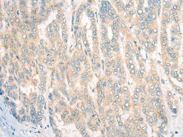 Immunohistochemistry of paraffin-embedded Human liver cancer tissue using CDKAL1 Polyclonal Antibody at dilution of 1:60(×200)