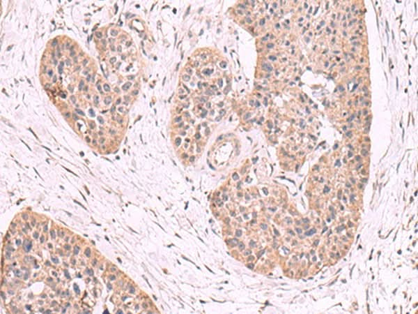 Immunohistochemistry of paraffin-embedded Human esophagus cancer tissue using MGP Polyclonal Antibody at dilution of 1:50(×200)