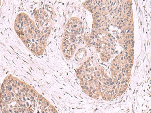 Immunohistochemistry of paraffin-embedded Human esophagus cancer tissue using MGP Polyclonal Antibody at dilution of 1:50(×200)