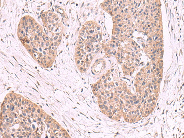 Immunohistochemistry of paraffin-embedded Human esophagus cancer tissue using MGP Polyclonal Antibody at dilution of 1:50(×200)