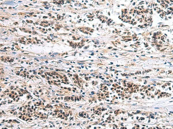 Immunohistochemistry of paraffin-embedded Human breast cancer tissue using CLCN7 Polyclonal Antibody at dilution of 1:105(×200)