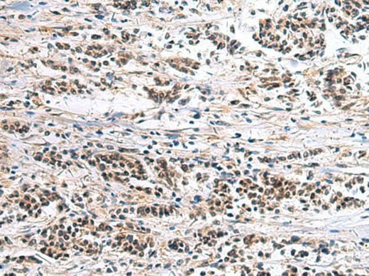 Immunohistochemistry of paraffin-embedded Human breast cancer tissue using CLCN7 Polyclonal Antibody at dilution of 1:105(×200)