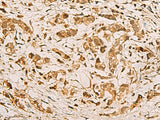 Immunohistochemistry of paraffin-embedded Human gastric cancer tissue using ZMAT4 Polyclonal Antibody at dilution of 1:65(×200)