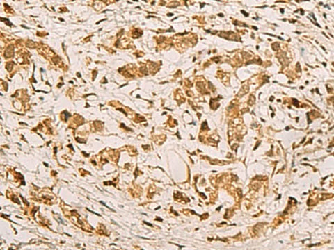 Immunohistochemistry of paraffin-embedded Human gastric cancer tissue using ZMAT4 Polyclonal Antibody at dilution of 1:65(×200)